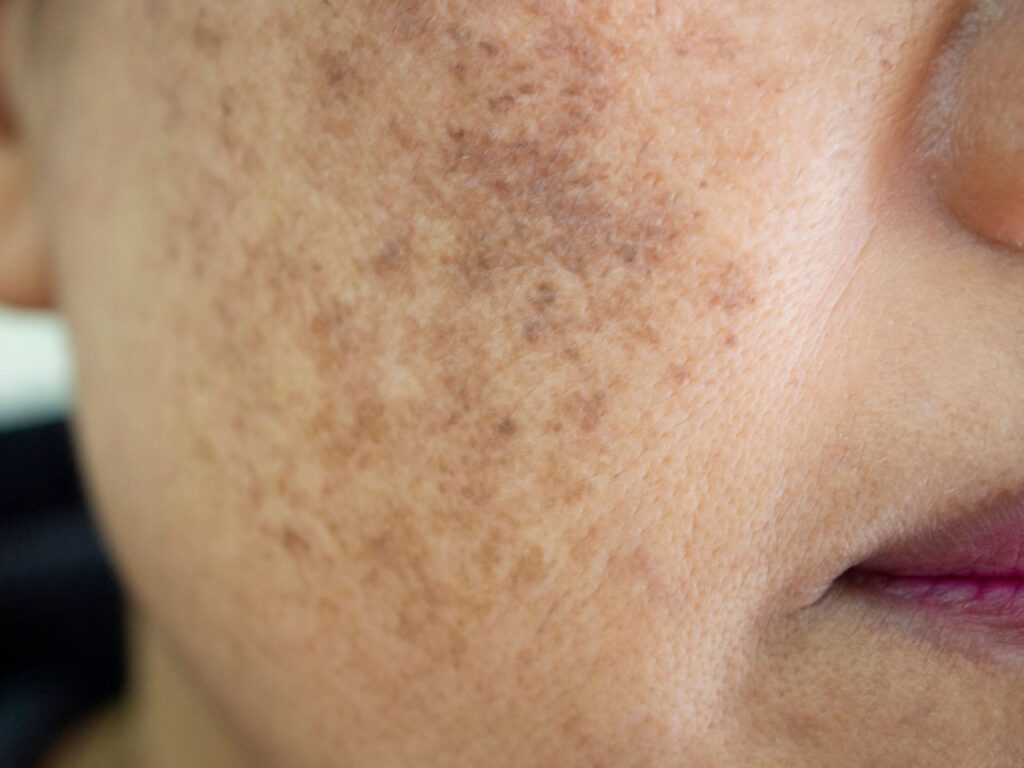 treatment for melasma houston tx