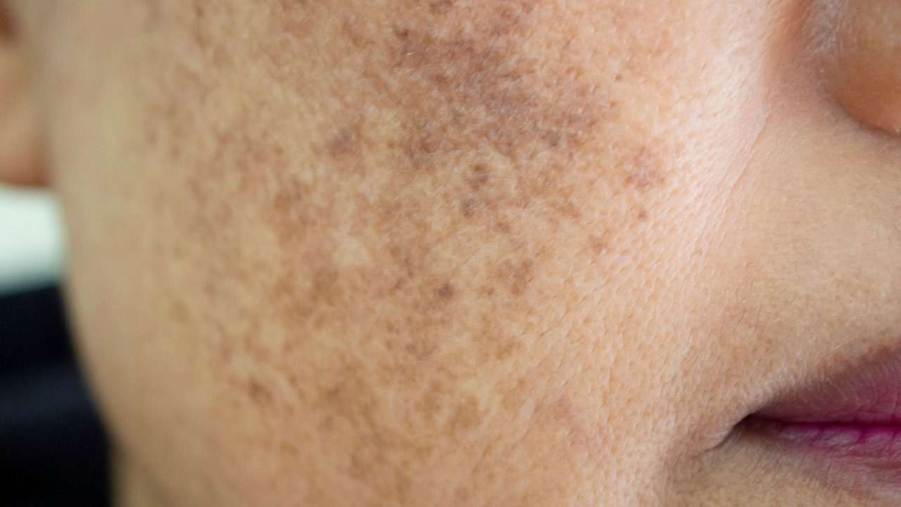 Melasma Treatment in Houston