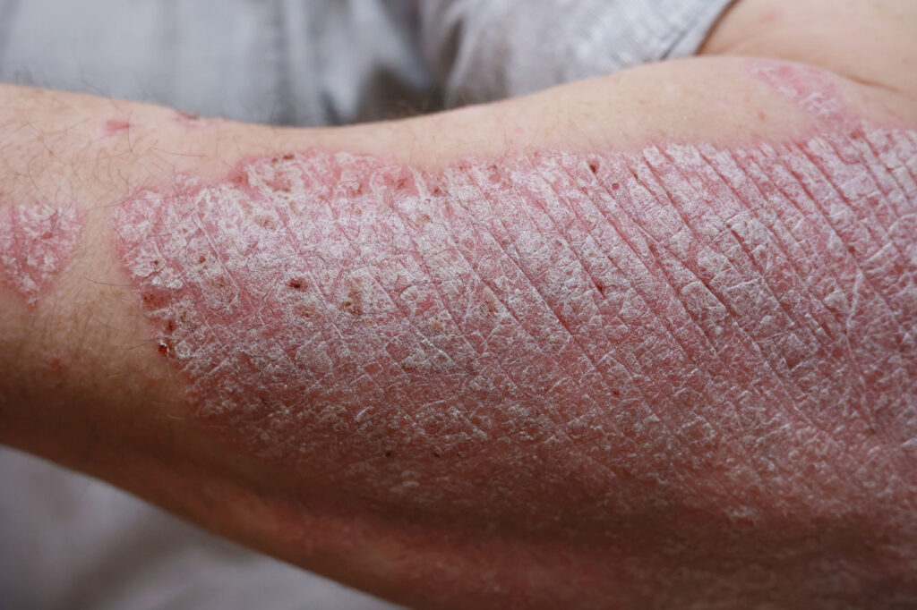 psoriasis treatment houston tx