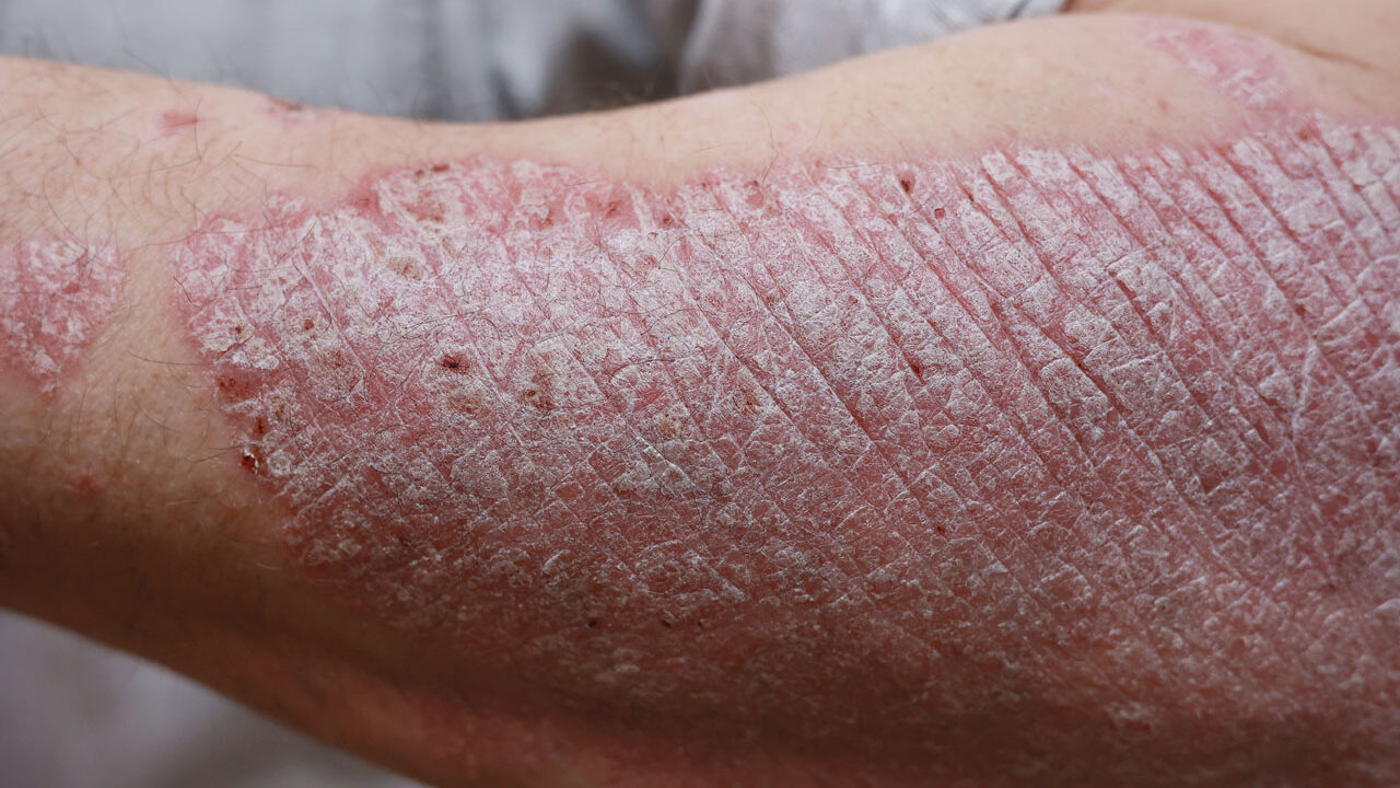 Psoriasis Treatment in Houston