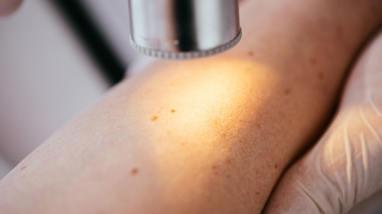 Houston Skin Cancer Screening