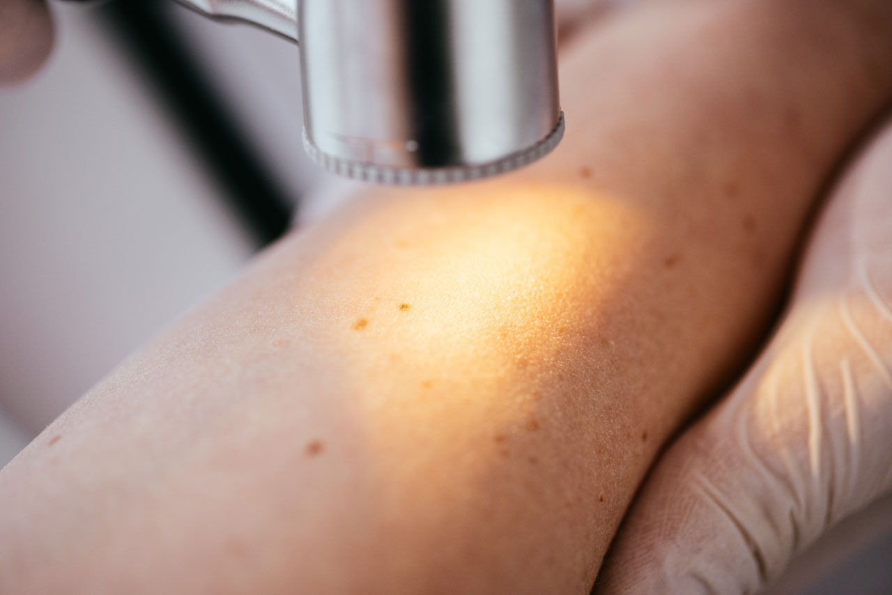 Skin Cancer Testing Houston Skin Cancer Screening - Houston Laser Skin Center