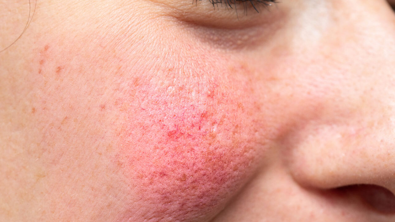 Rosacea Treatment in Houston