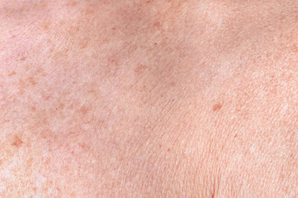 treatment for sun damaged skin in houston