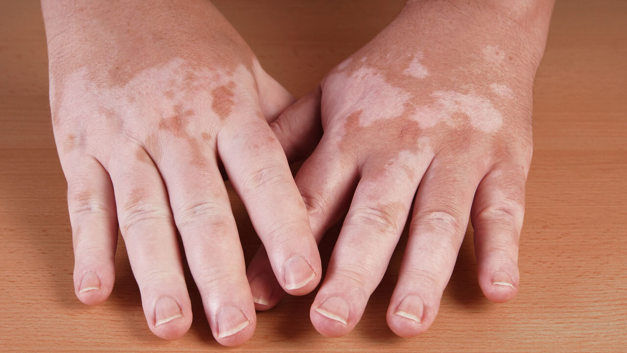 Vitiligo Treatment in Houston