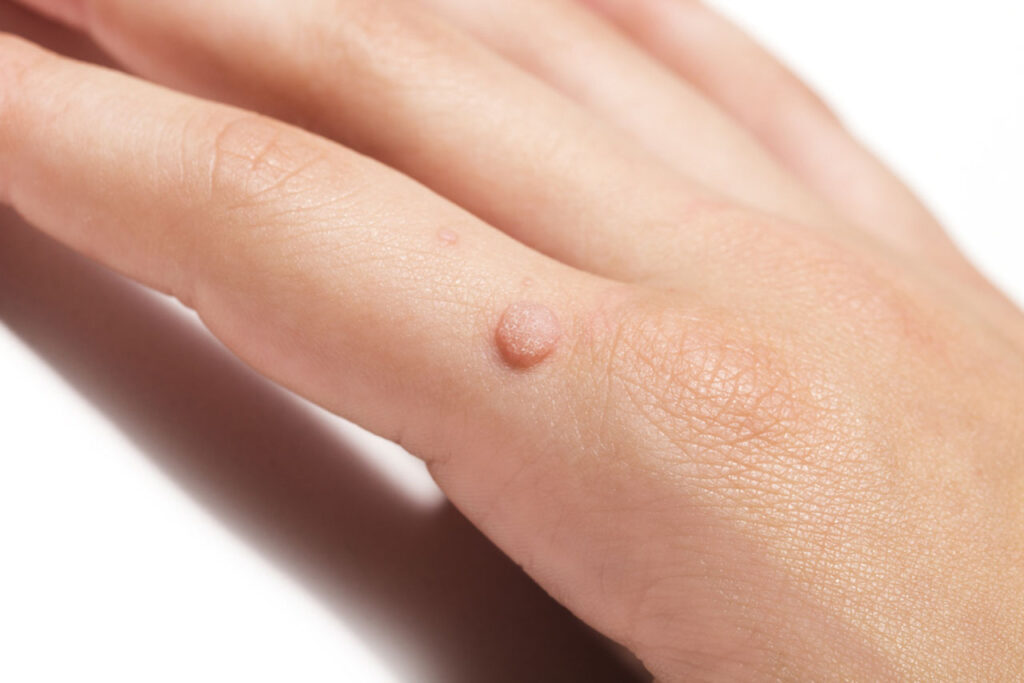 wart removal houston tx