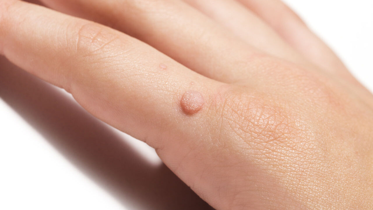Wart Removal In Houston